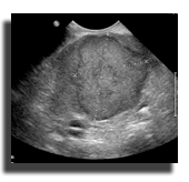 Splenic mass